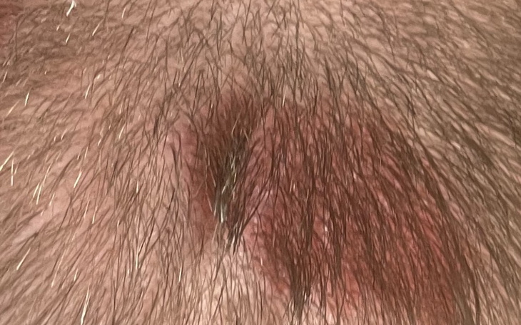 Zbiórka Złośliwy rak skóry - zdjęcie główne