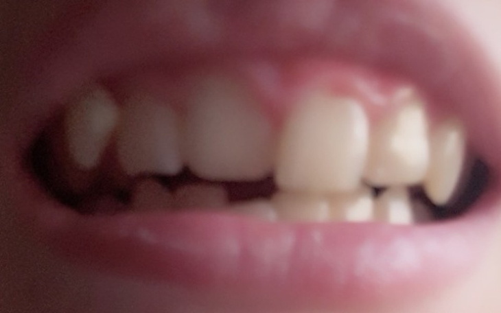 Zbiórka Aparat na zęby górny i dolny - zdjęcie główne