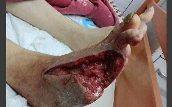 Ciężka rana na stopie, wymagająca pilnej interwencji medycznej.