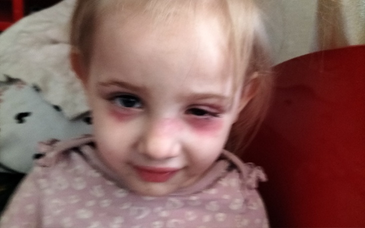 Mała dziewczynka z siniakami na twarzy, wyglądająca na zmartwioną.