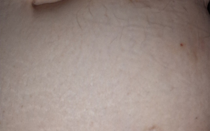 Zbliżenie na skórę, widoczne drobne detale.