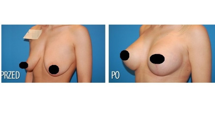 Zbiórka Operacja biustu po utracie wagi - zdjęcie główne