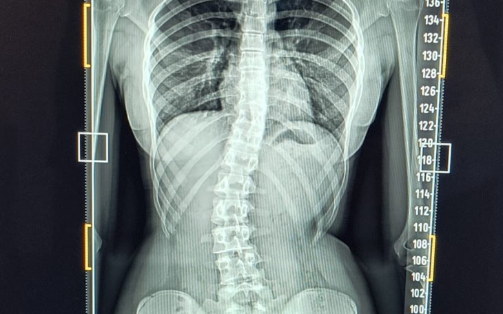 Zbiórka Gorset ortopedyczny dla Marylki - zdjęcie główne