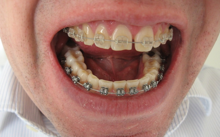 Zbiórka Aparat ortodontyczny dla taty - zdjęcie główne