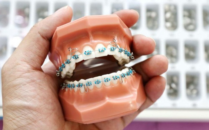 Zbiórka Aparat ortodontyczny, stały - zdjęcie główne