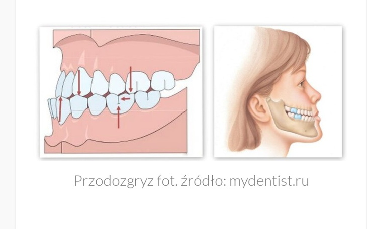 Zbiórka Zbieram na aparat na zęby .. - zdjęcie główne