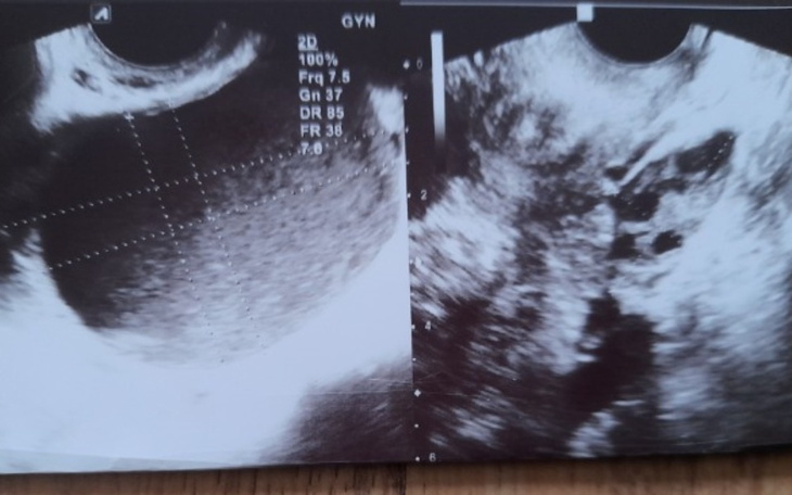 Zbiórka Operacja endometriozy IV st. - zdjęcie główne