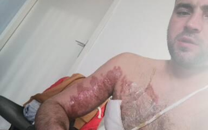 Zbiórka Koszty Leczenia Oparzenia - zdjęcie główne