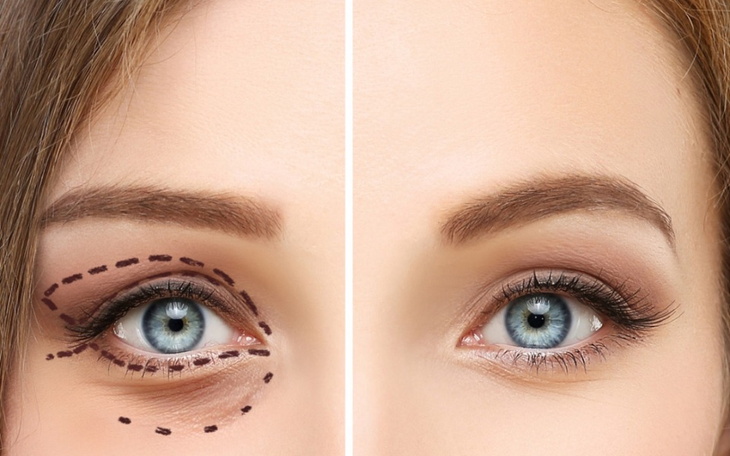 Zbiórka Zabieg na powieki - zdjęcie główne