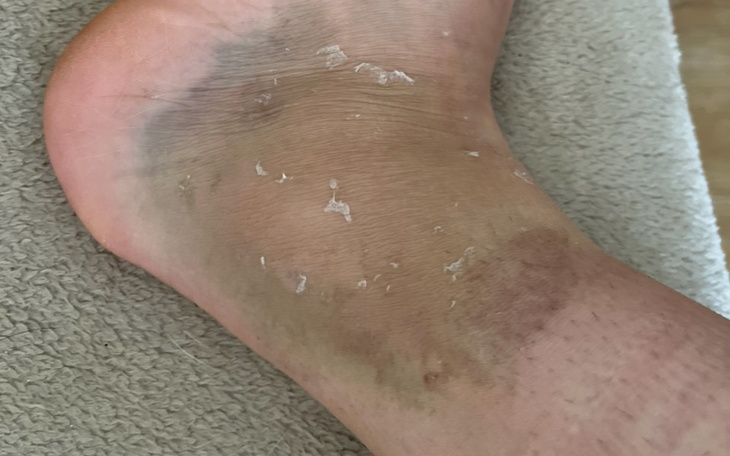 Zbiórka Operacja zerwanego więzadła atfl - zdjęcie główne