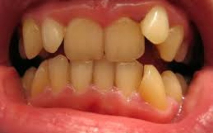 Zbiórka Zbiórka na aparat na zęby - zdjęcie główne