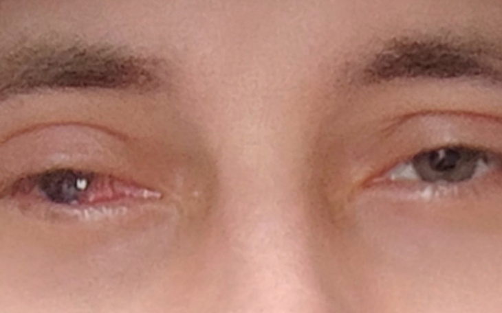 Zbliżenie na oczy osoby z różnymi kolorami tęczówek.