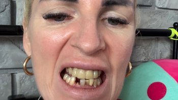 Zbiórka Koszty leczenia zębów po ciężkim leczeniu raka języka - miniaturka zdjęcia