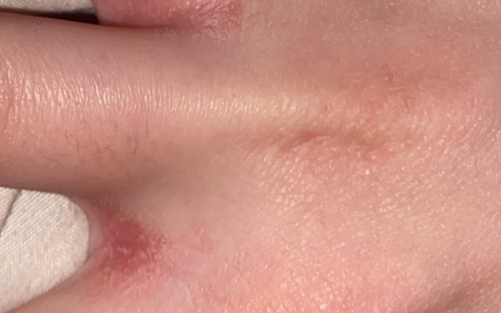 Zbiórka Na leczenia atopowego zapalenia - zdjęcie główne