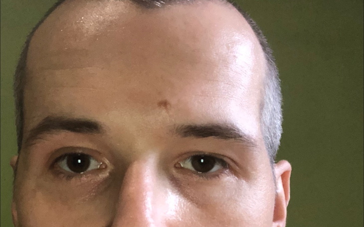 Mężczyzna z krótkimi włosami i blizną na czole.