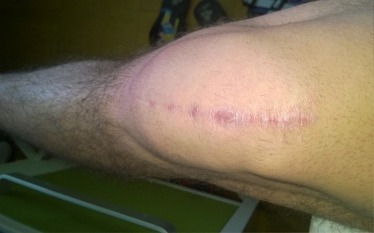 Zbiórka Zstrzyki - kolano po operacji - zdjęcie główne