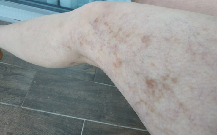 Zbiórka Laser na naczynka na nogach - zdjęcie główne