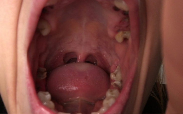 Zbiórka Implanty zygomatyczne-bez bólu. - zdjęcie główne