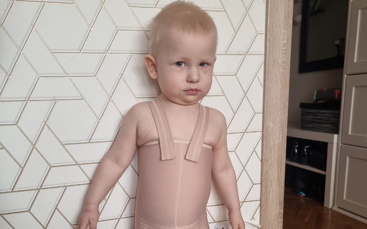 Zbiórka Leczenie po oparzeniu - zdjęcie główne