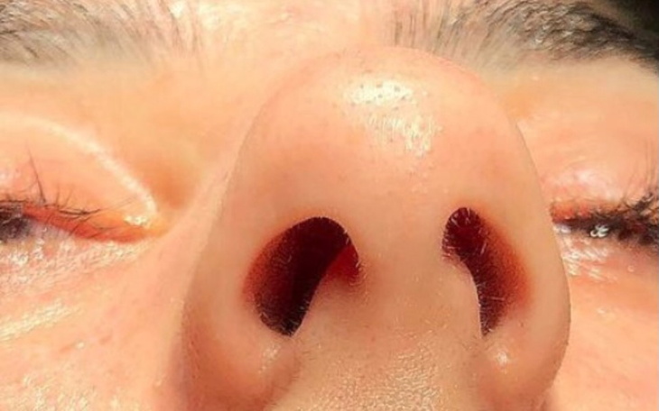 Zbiórka Zbiórka na korektę nosa - zdjęcie główne