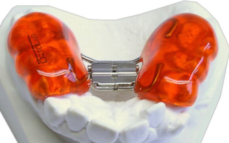 Zbiórka wada zgryzu aparat hassa - zdjęcie główne