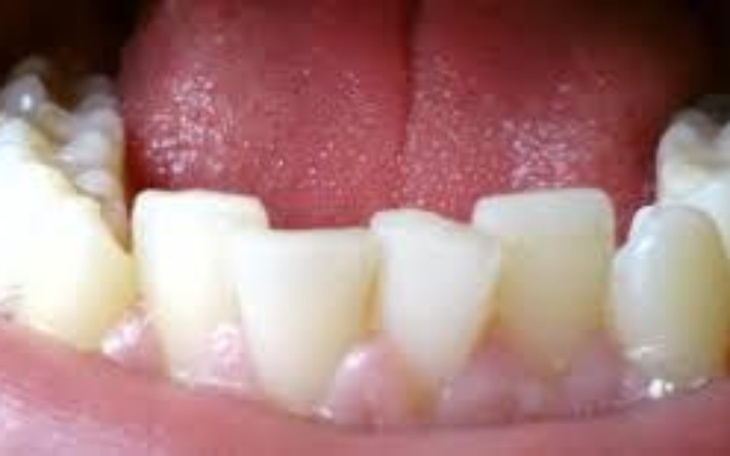 Zbiórka Zbieramy na aparat na zęby - zdjęcie główne