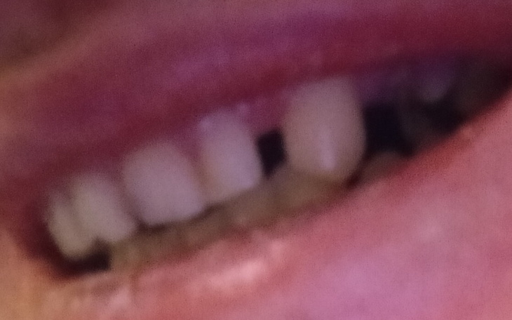 Zbiórka Na pomoc wstawienia zębów - zdjęcie główne