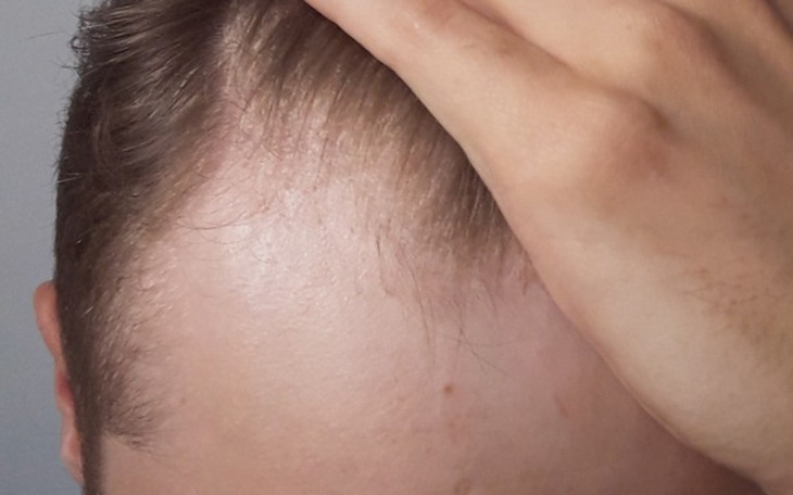 Zbiórka Przeszczep włosów dla nastolatka - zdjęcie główne