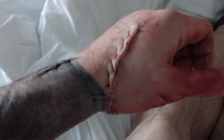 Ręka z widocznymi szwami po operacji.