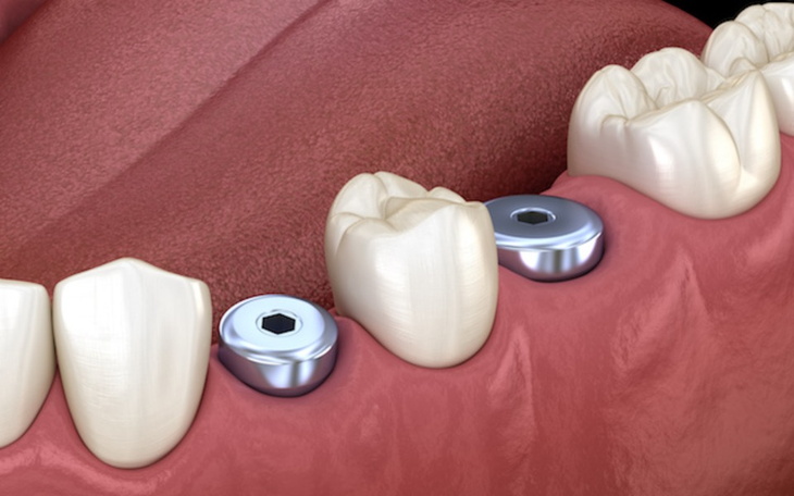 Zbiórka Błagam .Potrzebuje na implanty z - zdjęcie główne