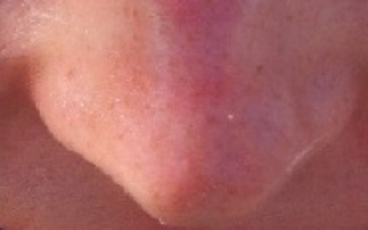 Zbiórka Wtórna operacja nosa - zdjęcie główne