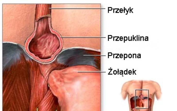 Zbiórka Precz z Przepukliną - zdjęcie główne