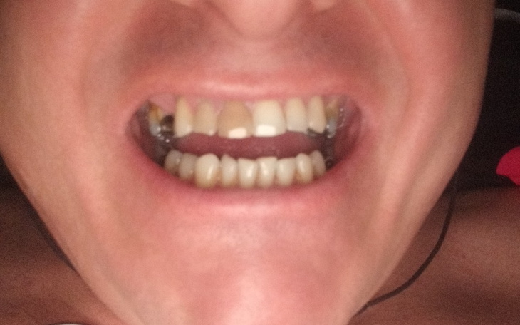 Zbiórka Na leczenie klawiaturyzębów - zdjęcie główne