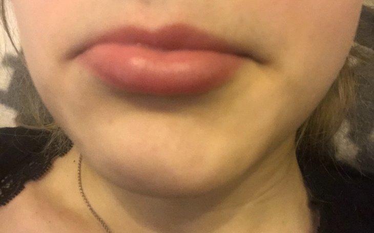 Zbiórka Powiększenie ust - zdjęcie główne