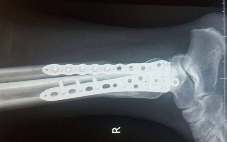 Zbiórka Operacja wyciągnięcia zespolenia - zdjęcie główne