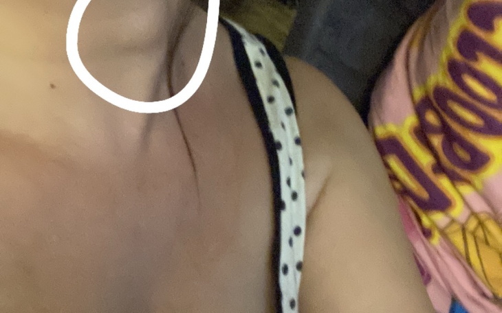 Zbiórka Torbiel tarczycy - zdjęcie główne