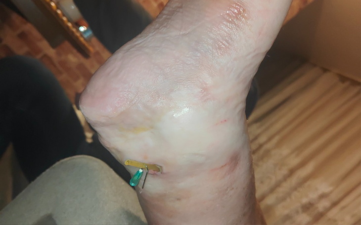 Zbiórka Proszę o pomoc w leczeniu nogi - zdjęcie główne