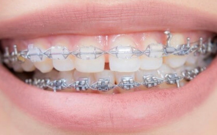 Zbiórka Aparatt ortodontycznyy - zdjęcie główne