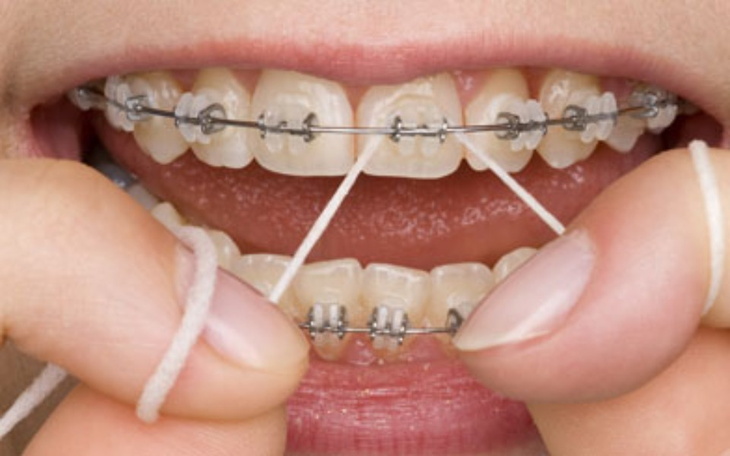 Zbiórka Aparat ortodontyczny na dół - zdjęcie główne