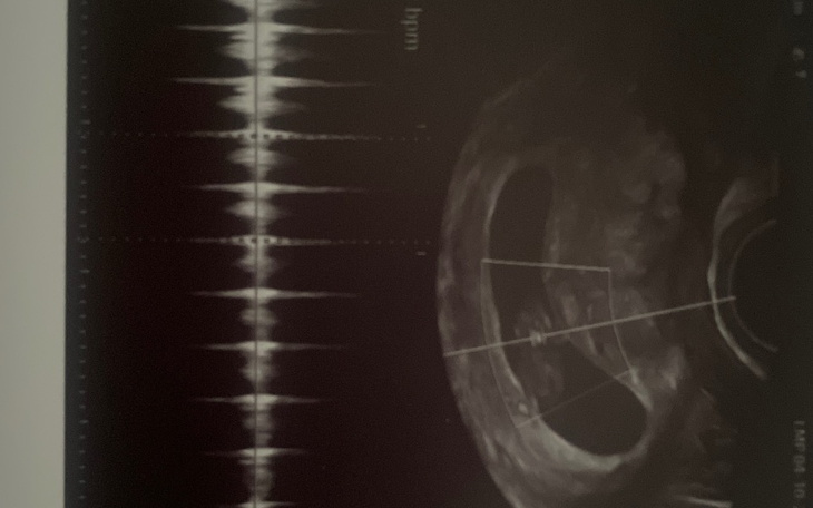 Zbiórka Biedna ciężarna bez domu. - zdjęcie główne