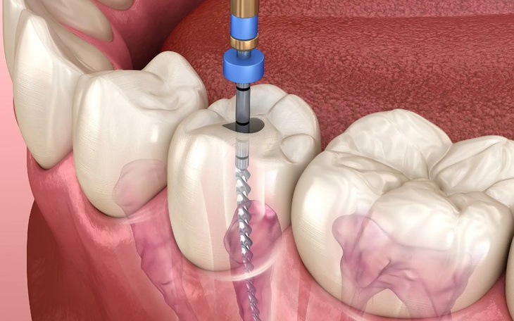 Zbiórka Leczenie zębów - kanałowe - zdjęcie główne