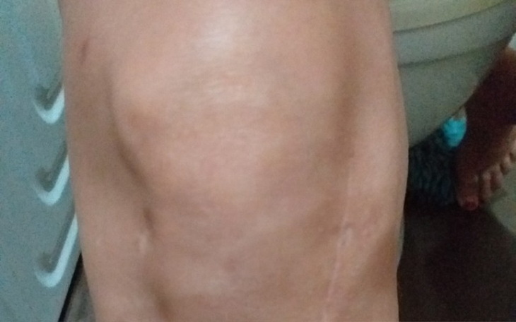 Zbiórka Endoproteza kolana - zdjęcie główne