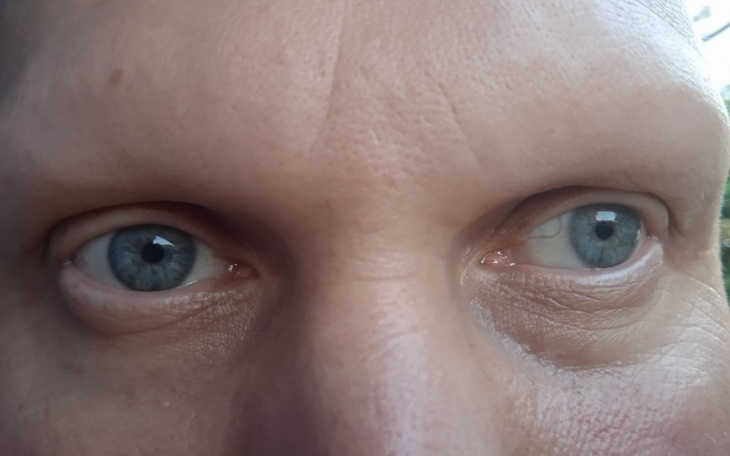 Zbiórka Leczenie hormonalne brak włosów - zdjęcie główne