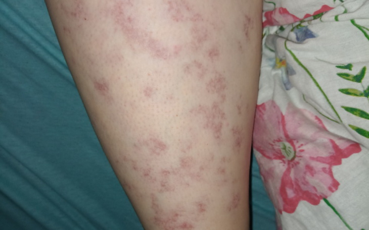 Zbiórka Laser na naczyniaka - zdjęcie główne