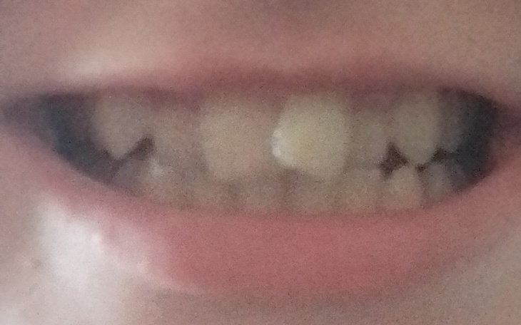 Zbiórka Komfort życia-aparat na zęby - zdjęcie główne