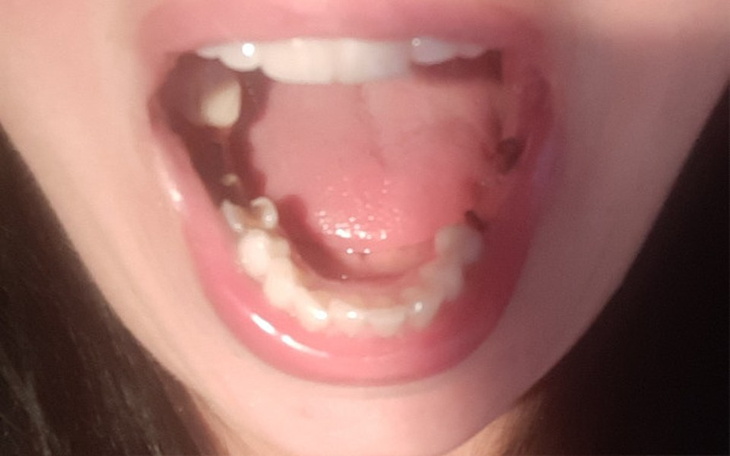 Zbiórka nowe zęby dla sylwi - zdjęcie główne