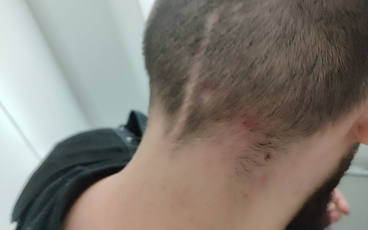 Widok na tył głowy mężczyzny z blizną.