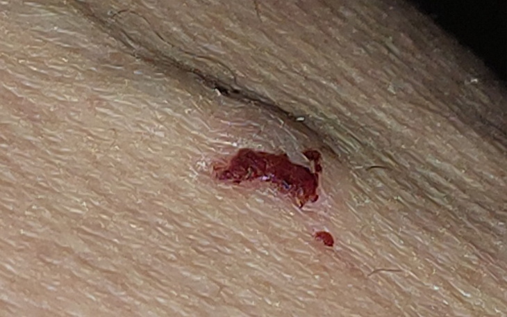 Zbliżenie na ranę na skórze.