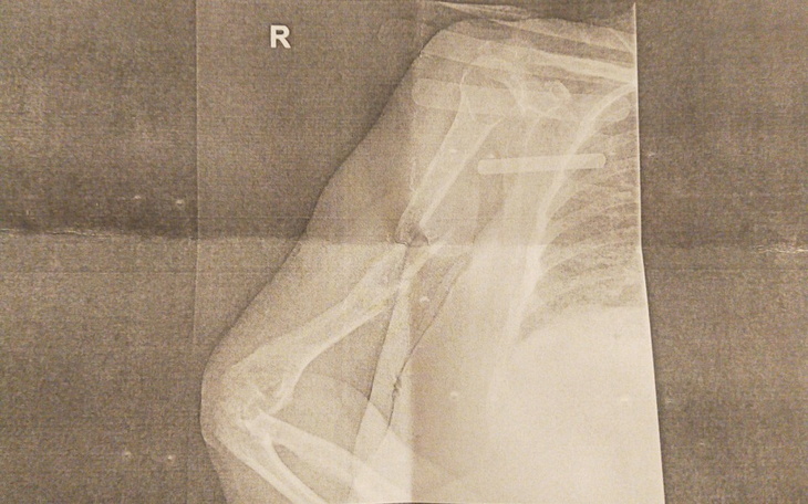 Zbiórka Złamanie barku i ramienia. - zdjęcie główne