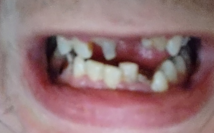 Zbiórka Naprawa ubytków zębowych - zdjęcie główne